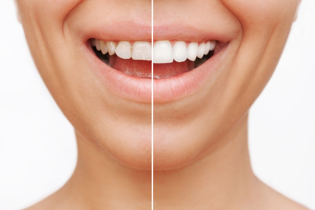 sonrisa-antes-despues-carillas-dentales-dentistas
